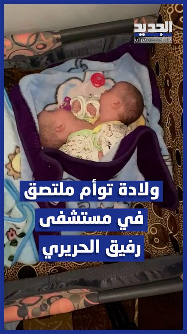 بالفيديو: ولادة توأم ملتصق في مستشفى رفيق الحريري